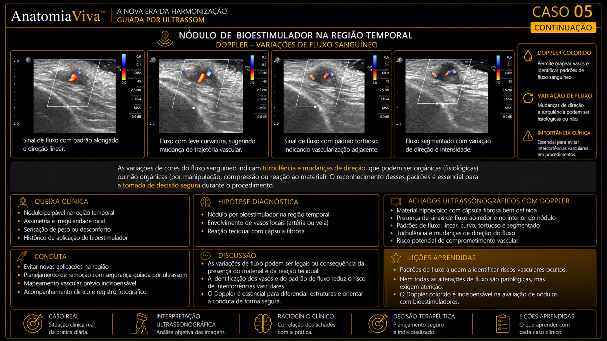 Nódulo de bioestimulador com Doppler